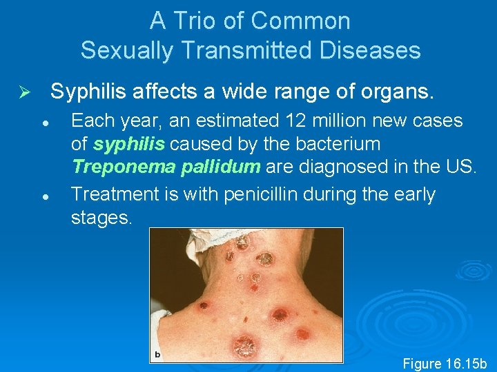 A Trio of Common Sexually Transmitted Diseases Syphilis affects a wide range of organs.