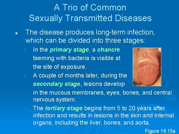 A Trio of Common Sexually Transmitted Diseases l The disease produces long term infection,