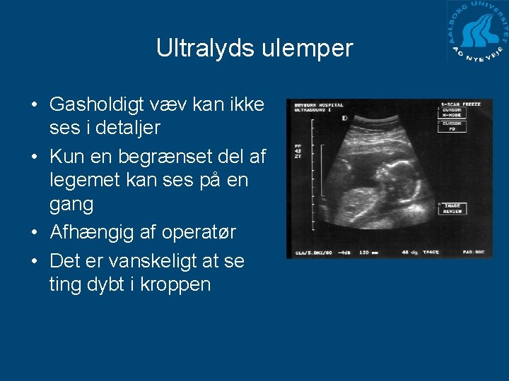 Ultralyds ulemper • Gasholdigt væv kan ikke ses i detaljer • Kun en begrænset