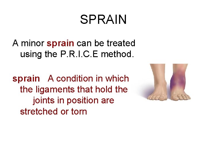 SPRAIN A minor sprain can be treated using the P. R. I. C. E