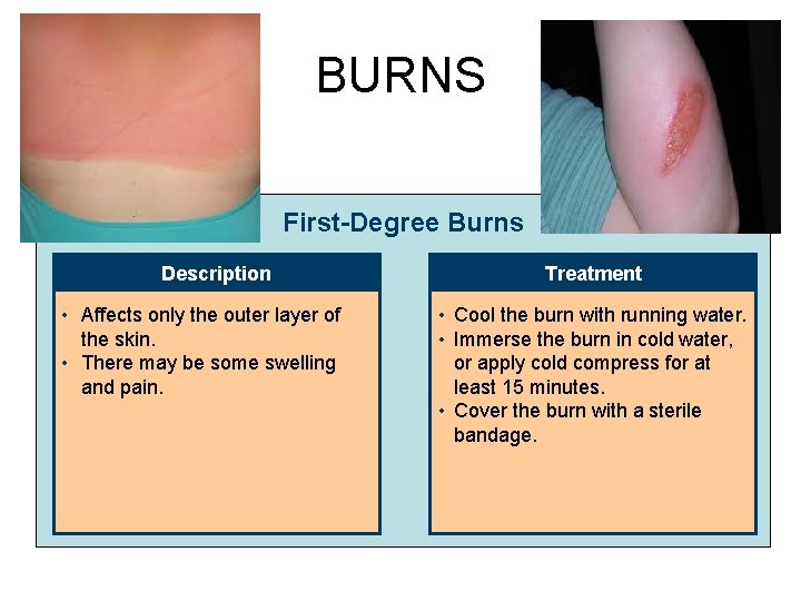 BURNS First-Degree Burns Description • Affects only the outer layer of the skin. •