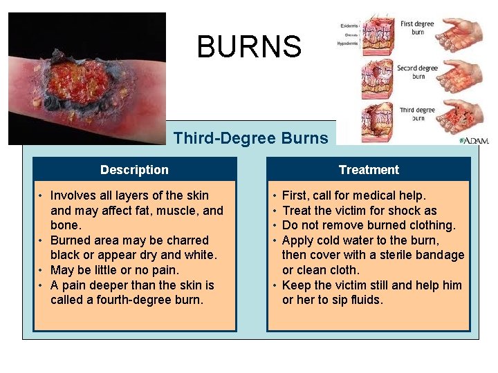 BURNS Third-Degree Burns Description • Involves all layers of the skin and may affect