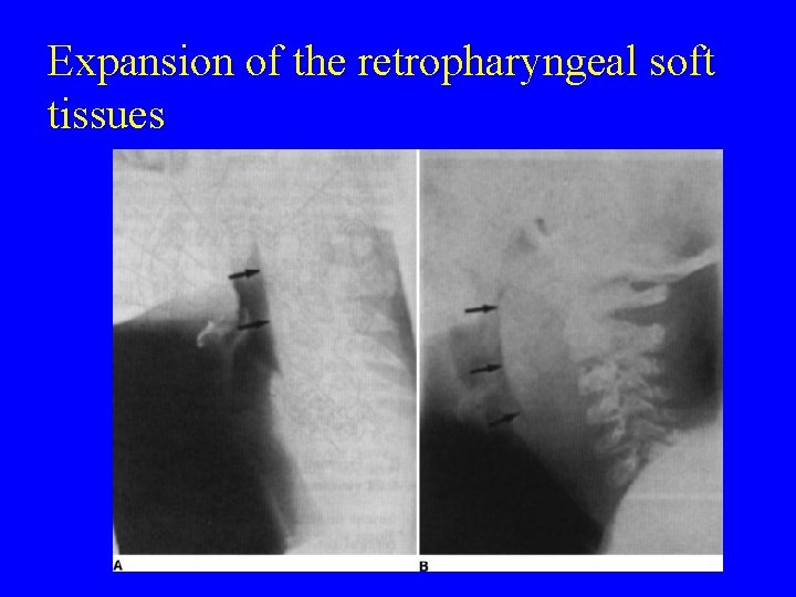 Expansion of the retropharyngeal soft tissues 