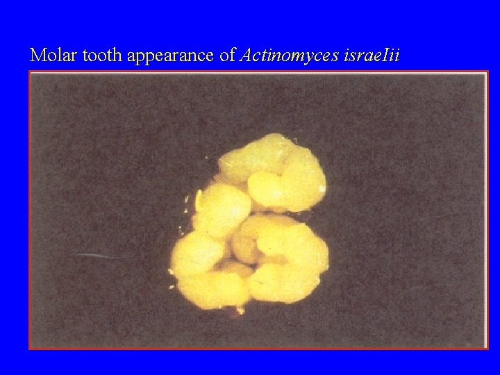 Molar tooth appearance of Actinomyces israe. Iii 
