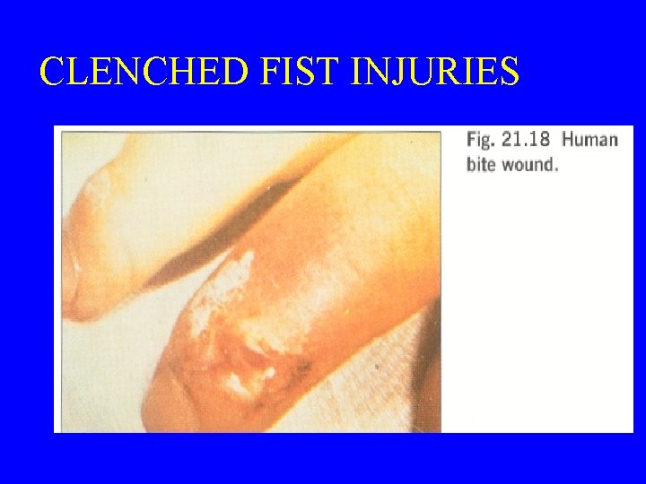 CLENCHED FIST INJURIES 