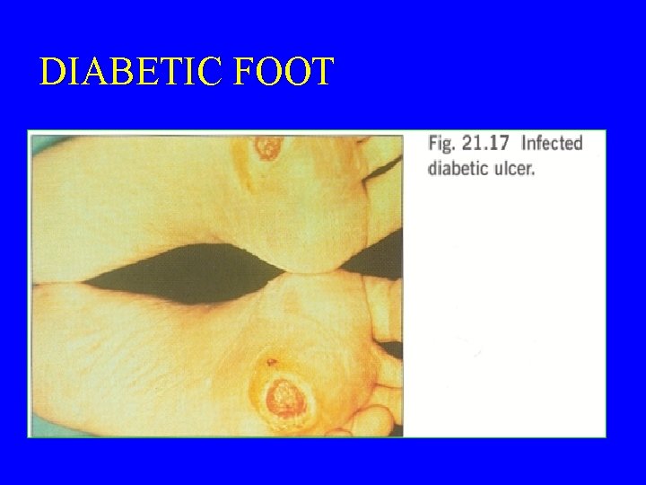 DIABETIC FOOT 