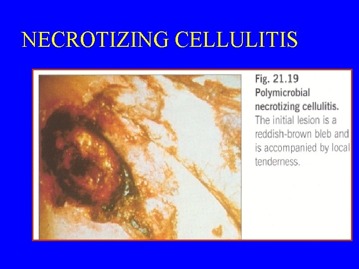 NECROTIZING CELLULITIS 