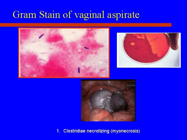 Gram Stain of vaginal aspirate 1. Clostridiae necrotizing (myonecrosis) 