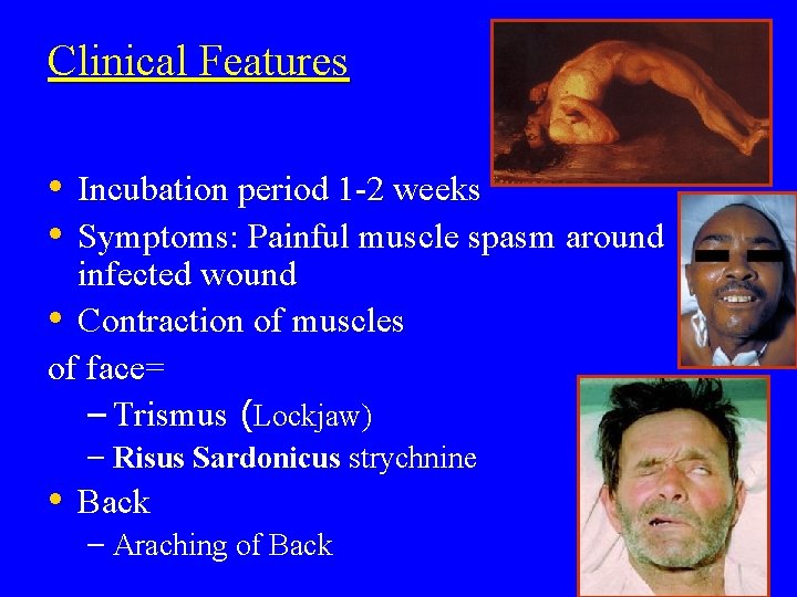 Clinical Features • Incubation period 1 -2 weeks • Symptoms: Painful muscle spasm around