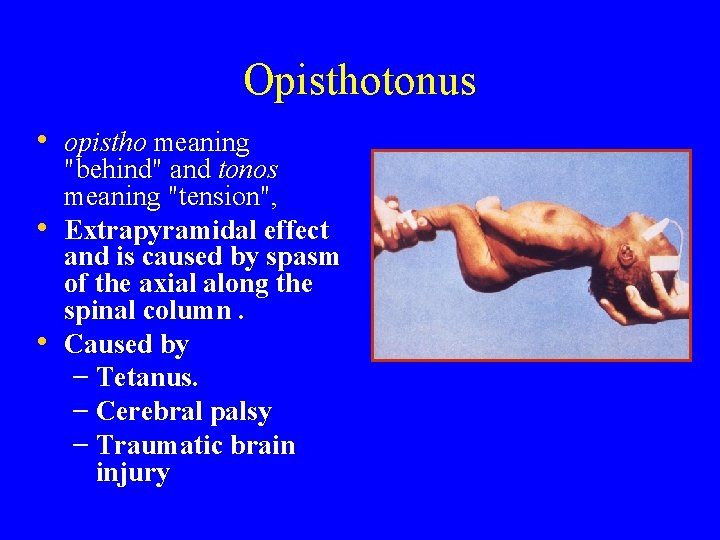 Opisthotonus • opistho meaning • • "behind" and tonos meaning "tension", Extrapyramidal effect and