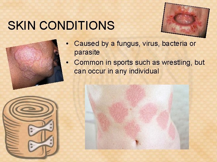 SKIN CONDITIONS • Caused by a fungus, virus, bacteria or parasite • Common in