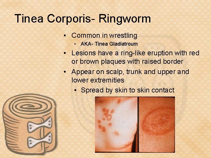 Tinea Corporis- Ringworm • Common in wrestling • AKA- Tinea Gladiatroum • Lesions have