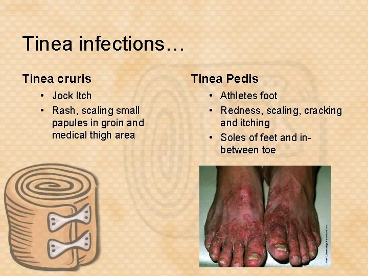 Tinea infections… Tinea cruris • Jock Itch • Rash, scaling small papules in groin