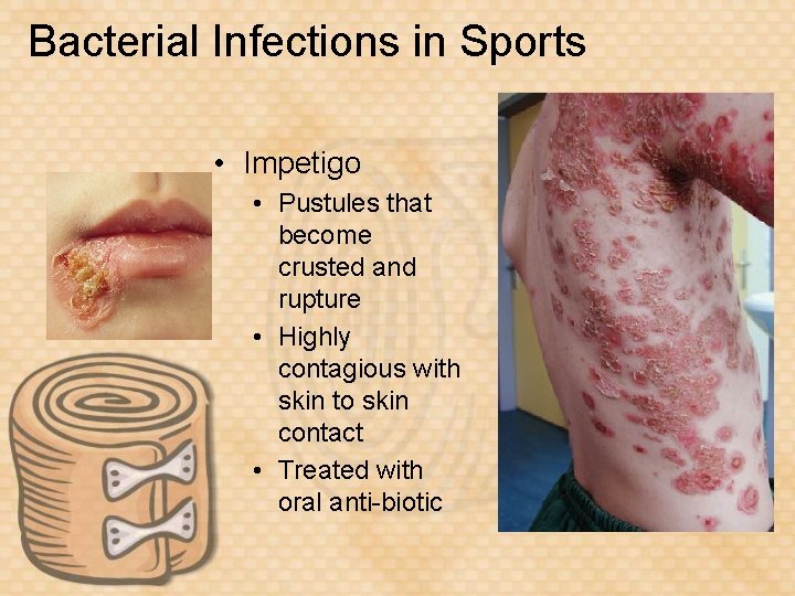 Bacterial Infections in Sports • Impetigo • Pustules that become crusted and rupture •