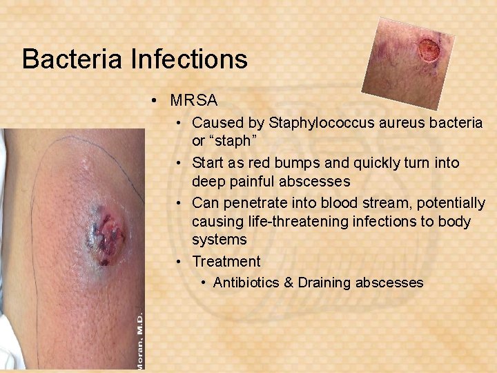 Bacteria Infections • MRSA • Caused by Staphylococcus aureus bacteria or “staph” • Start