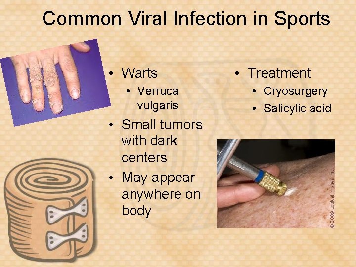 Common Viral Infection in Sports • Warts • Verruca vulgaris • Small tumors with