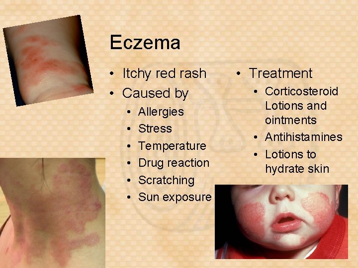 Eczema • Itchy red rash • Caused by • • • Allergies Stress Temperature