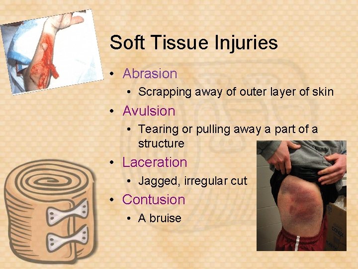 Soft Tissue Injuries • Abrasion • Scrapping away of outer layer of skin •