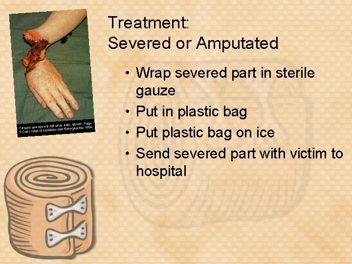 Treatment: Severed or Amputated • Wrap severed part in sterile gauze • Put in