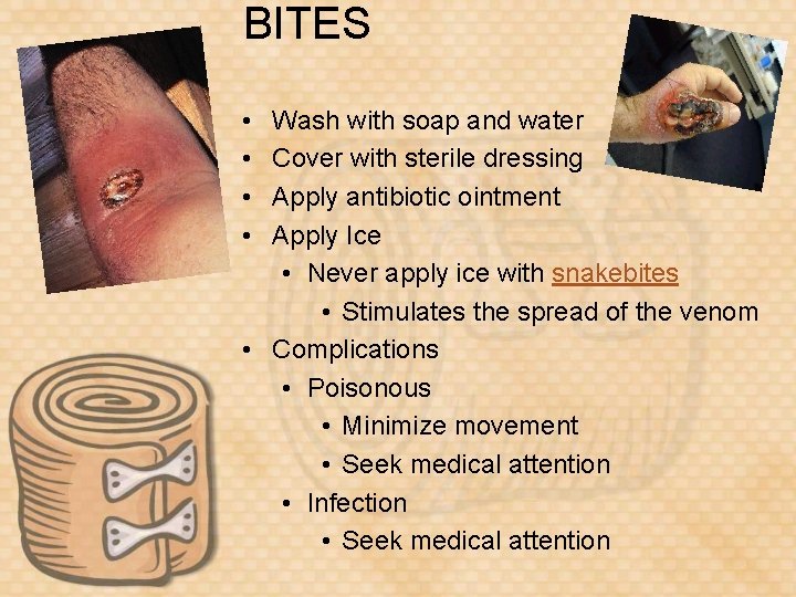 BITES • • Wash with soap and water Cover with sterile dressing Apply antibiotic