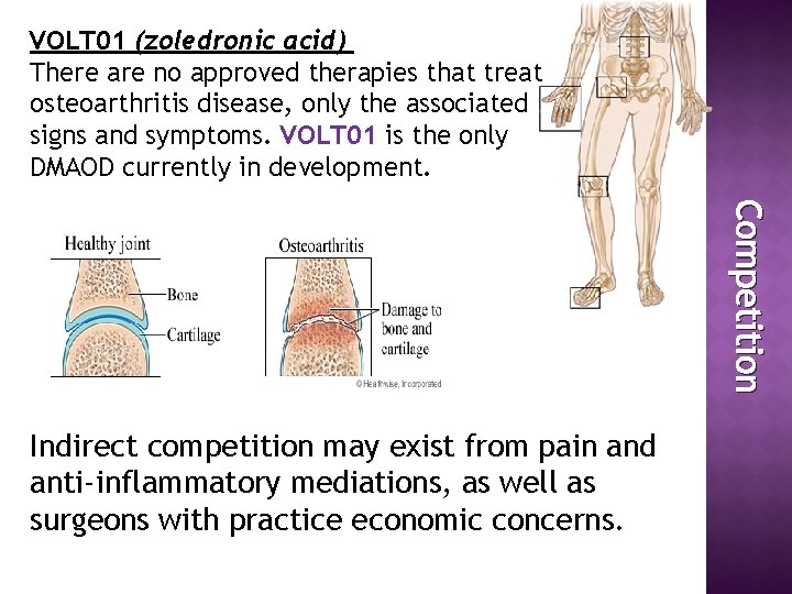 VOLT 01 (zoledronic acid) There are no approved therapies that treat osteoarthritis disease, only