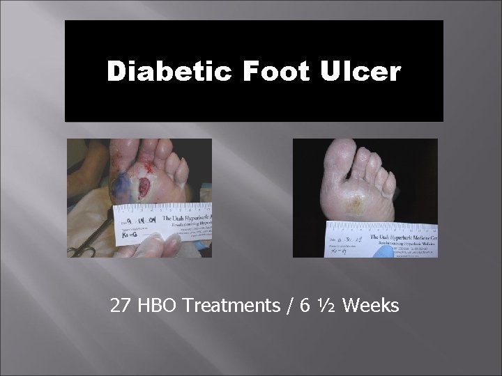 Diabetic Foot Ulcer 27 HBO Treatments / 6 ½ Weeks 