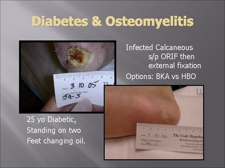 Diabetes & Osteomyelitis Infected Calcaneous s/p ORIF then external fixation Options: BKA vs HBO