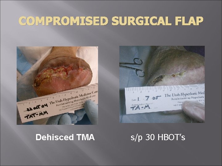 COMPROMISED SURGICAL FLAP Dehisced TMA s/p 30 HBOT’s 