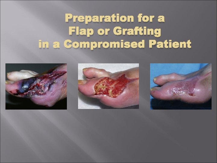 Preparation for a Flap or Grafting in a Compromised Patient 