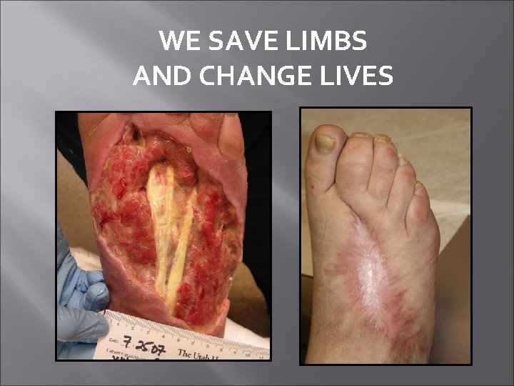 WE SAVE LIMBS AND CHANGE LIVES 