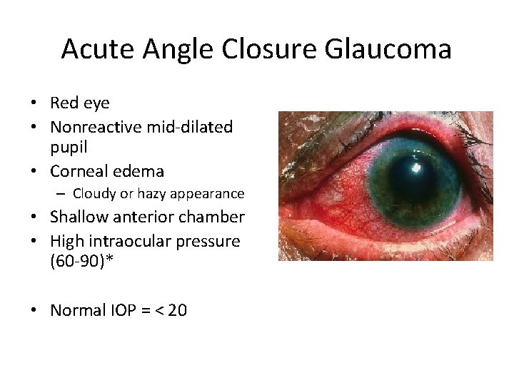 Acute Angle Closure Glaucoma • Red eye • Nonreactive mid-dilated pupil • Corneal edema