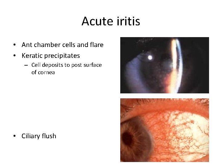 Acute iritis • Ant chamber cells and flare • Keratic precipitates – Cell deposits