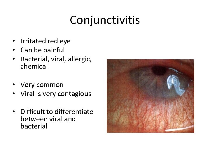 Conjunctivitis • Irritated red eye • Can be painful • Bacterial, viral, allergic, chemical