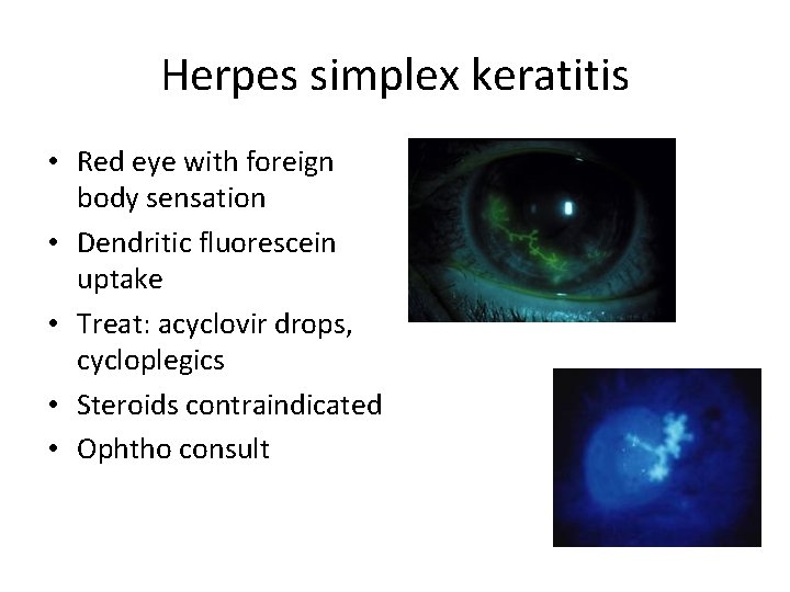 Herpes simplex keratitis • Red eye with foreign body sensation • Dendritic fluorescein uptake