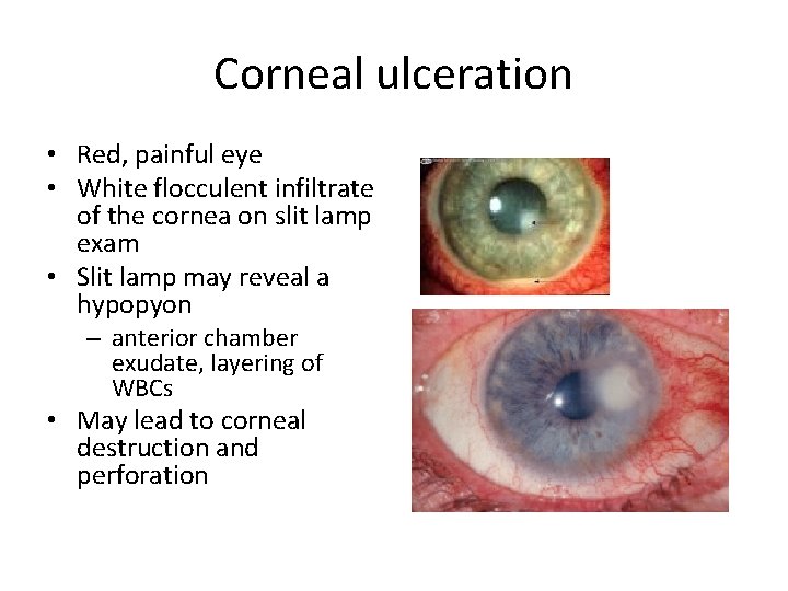 Corneal ulceration • Red, painful eye • White flocculent infiltrate of the cornea on