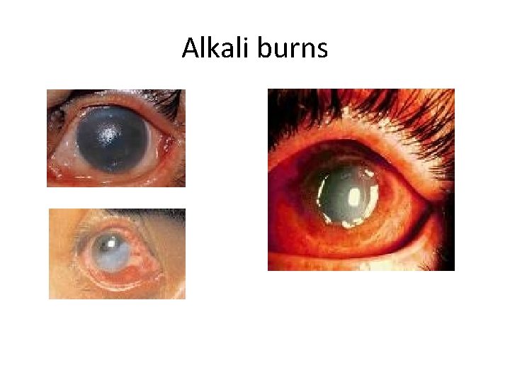 Alkali burns 