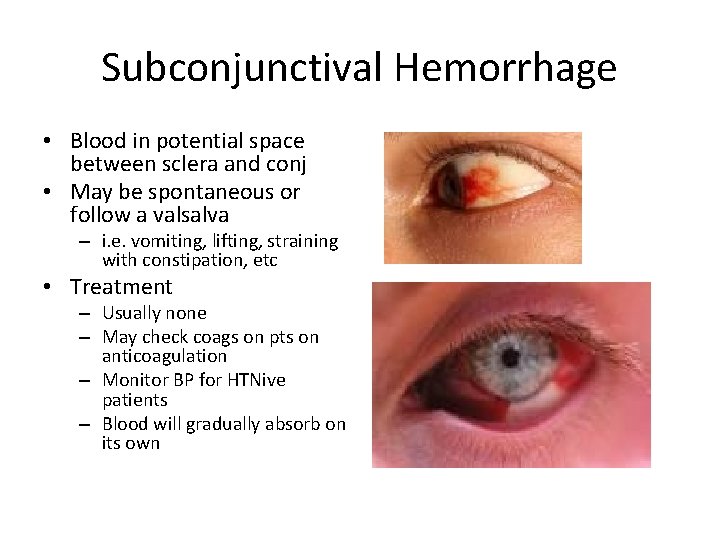 Subconjunctival Hemorrhage • Blood in potential space between sclera and conj • May be