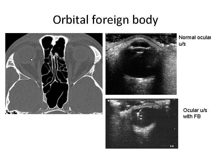 Orbital foreign body Normal ocular u/s Ocular u/s with FB 