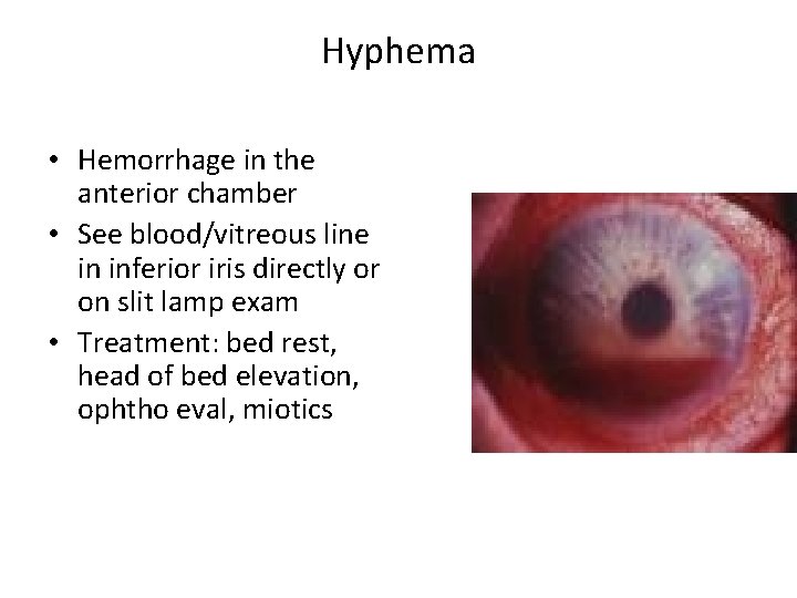 Hyphema • Hemorrhage in the anterior chamber • See blood/vitreous line in inferior iris