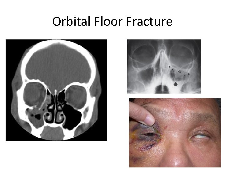 Orbital Floor Fracture 