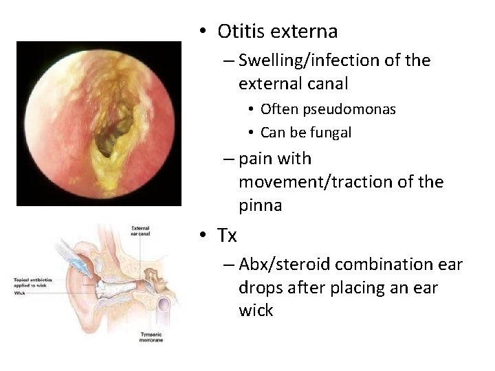  • Otitis externa – Swelling/infection of the external canal • Often pseudomonas •
