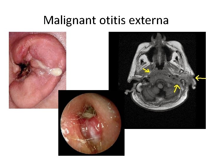 Malignant otitis externa 