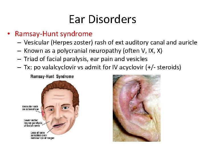 Ear Disorders • Ramsay-Hunt syndrome – – Vesicular (Herpes zoster) rash of ext auditory