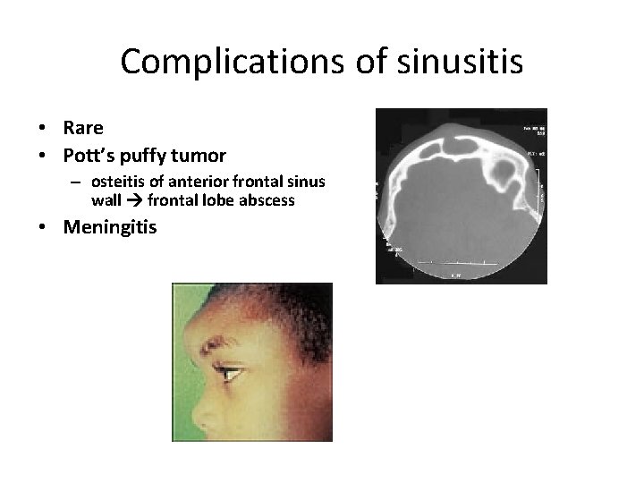 Complications of sinusitis • Rare • Pott’s puffy tumor – osteitis of anterior frontal