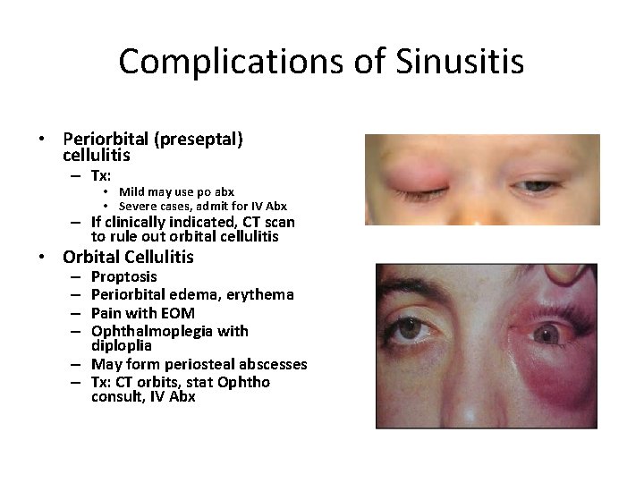 Complications of Sinusitis • Periorbital (preseptal) cellulitis – Tx: • Mild may use po