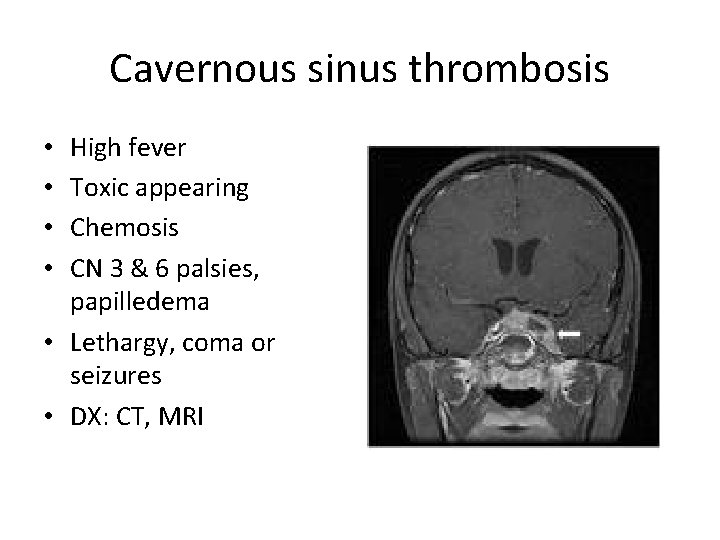 Cavernous sinus thrombosis High fever Toxic appearing Chemosis CN 3 & 6 palsies, papilledema