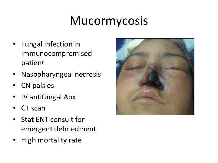 Mucormycosis • Fungal infection in immunocompromised patient • Nasopharyngeal necrosis • CN palsies •