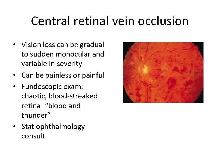 Central retinal vein occlusion • Vision loss can be gradual to sudden monocular and