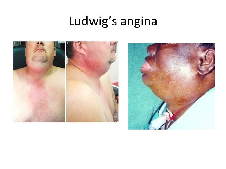 Ludwig’s angina 