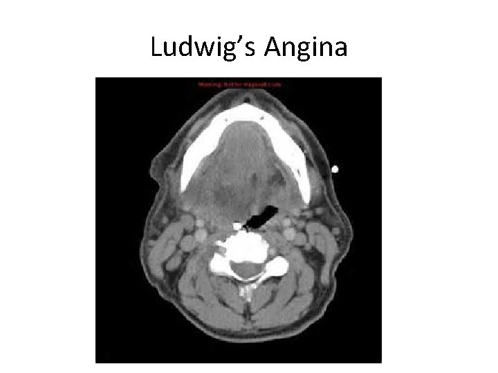 Ludwig’s Angina 